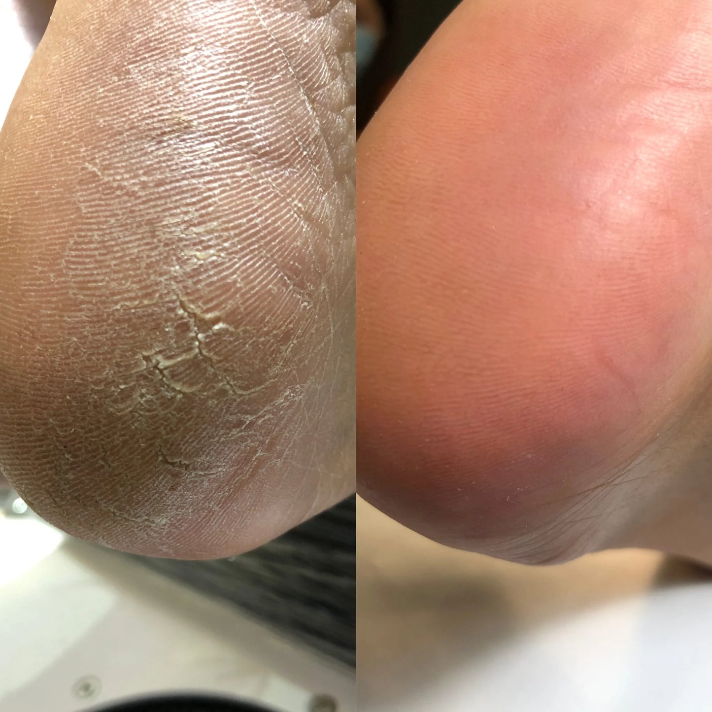 Nailsoftheday Podology+ Keratolyt für Füße, 100 ml – 20% Urea für sanfte Entfernung von Hornhaut