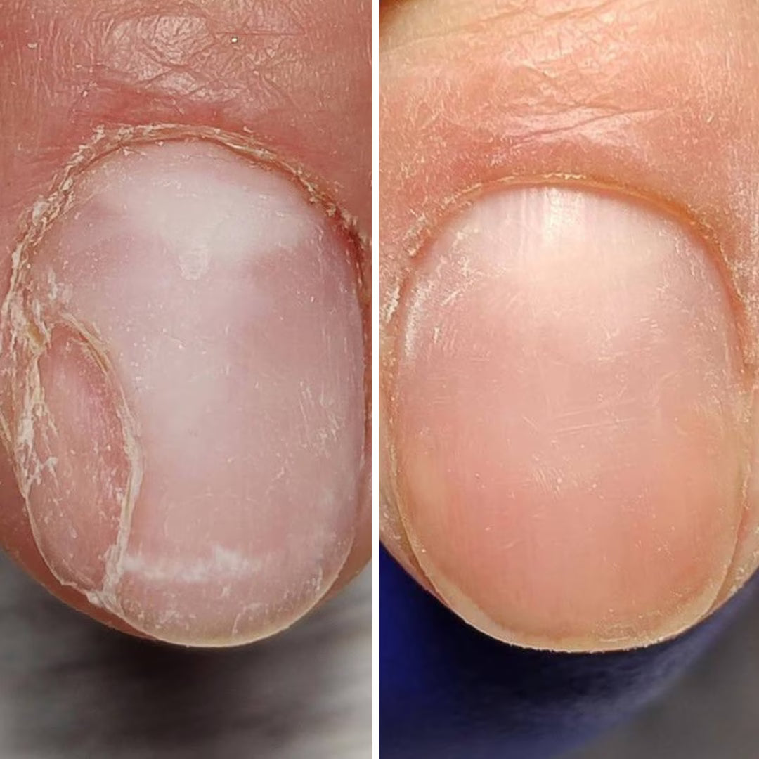 Resultum Onistopix Oil – regenerierendes Nagelöl für beanspruchte Nägel, Onycholyse-Pflege & intensive Nagelhautpflege