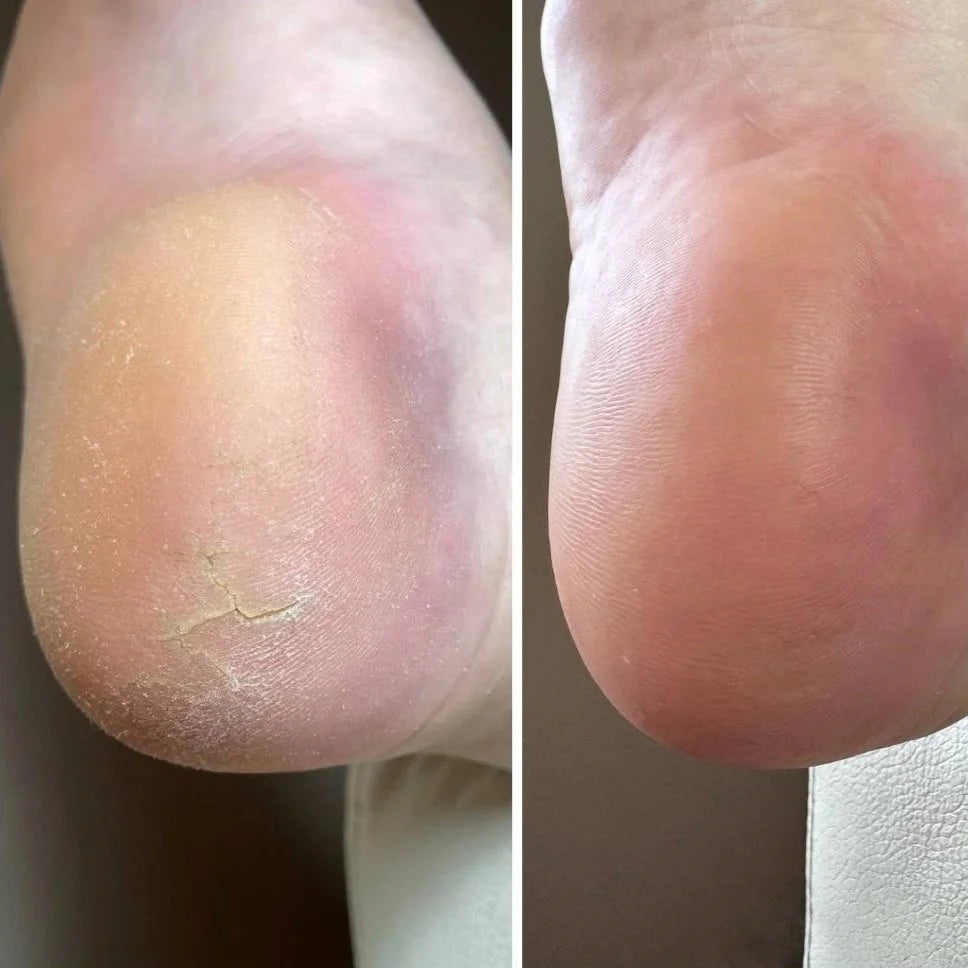 Nailsoftheday Podology+ Risscreme für Hände und Füße, 30 ml – Feuchtigkeit und Regeneration mit 12% Urea