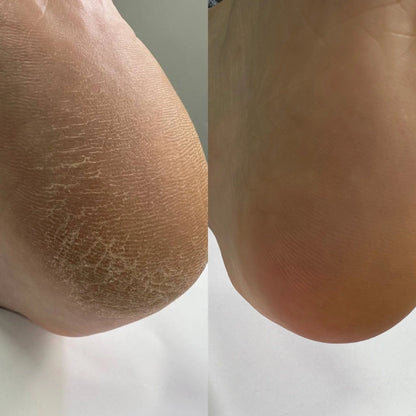 Nailsoftheday Podology+ Keratolyt für Füße, 100 ml – 20% Urea für sanfte Entfernung von Hornhaut