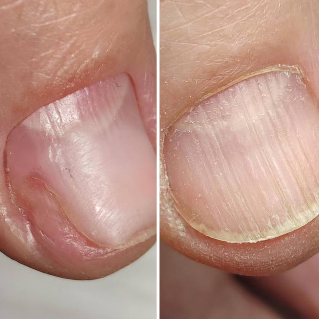 Resultum Onistopix Oil – regenerierendes Nagelöl für beanspruchte Nägel, Onycholyse-Pflege & intensive Nagelhautpflege