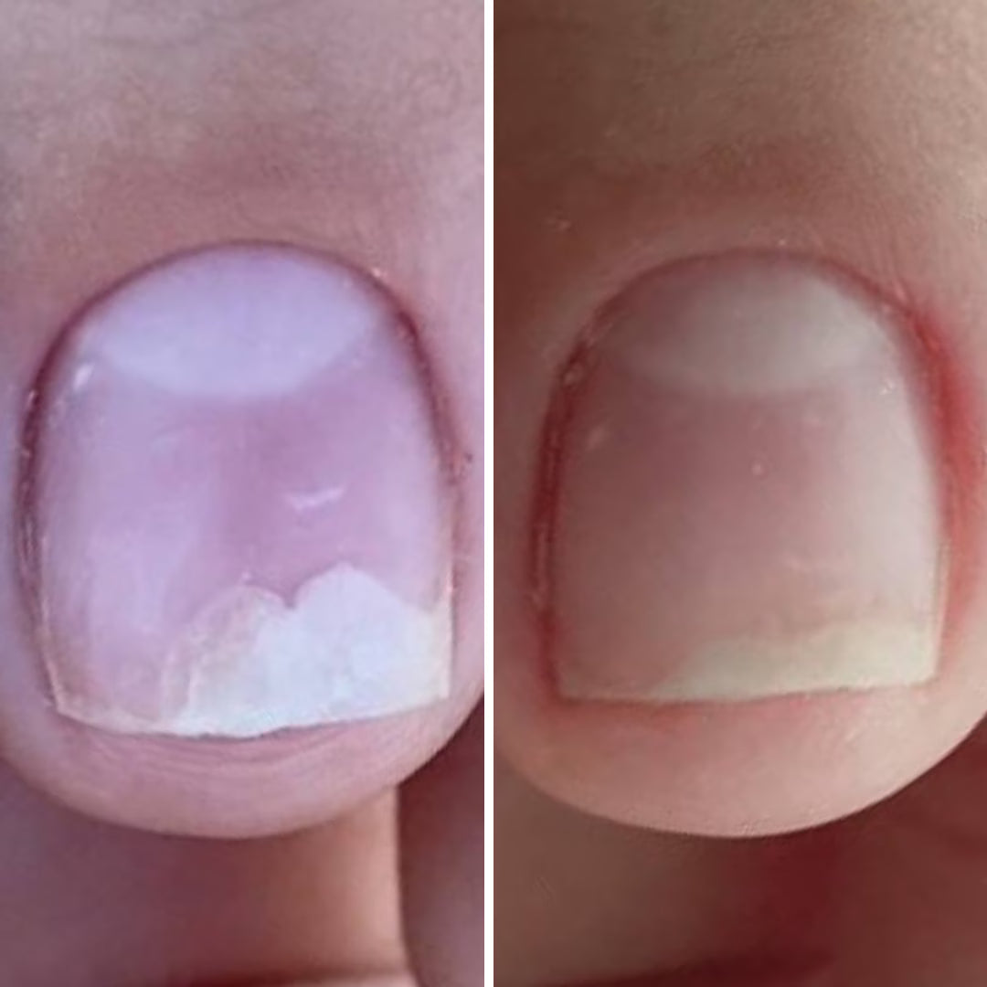 Resultum Onistopix Oil – regenerierendes Nagelöl für beanspruchte Nägel, Onycholyse-Pflege & intensive Nagelhautpflege