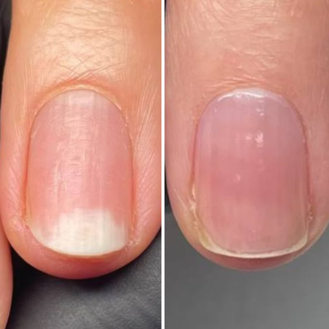 Resultum Onistopix Oil – regenerierendes Nagelöl für beanspruchte Nägel, Onycholyse-Pflege & intensive Nagelhautpflege