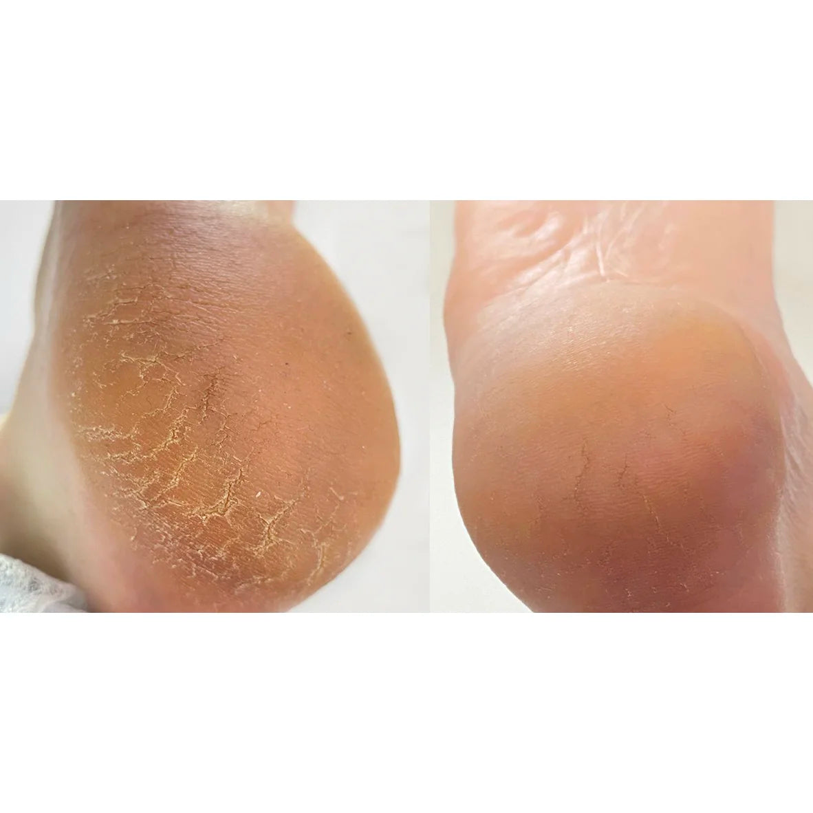 Nailsoftheday Podology+ Risscreme für Hände und Füße, 30 ml – Feuchtigkeit und Regeneration mit 12% Urea